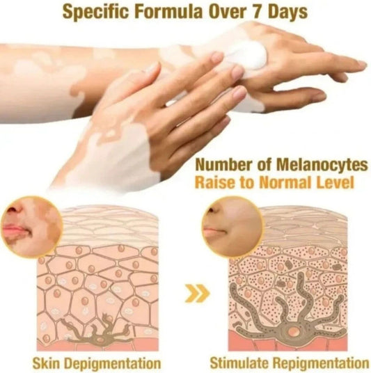 VitiGO™ Revitalizing Bee Venom Cream | Effective Solution for Vitiligo, White Spots & Skin Revitalization - Pack of 3