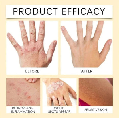 VitiGO™ Revitalizing Bee Venom Cream | Effective Solution for Vitiligo, White Spots & Skin Revitalization  - Pack of 3